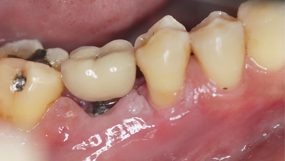 Iekaisums ap implantu