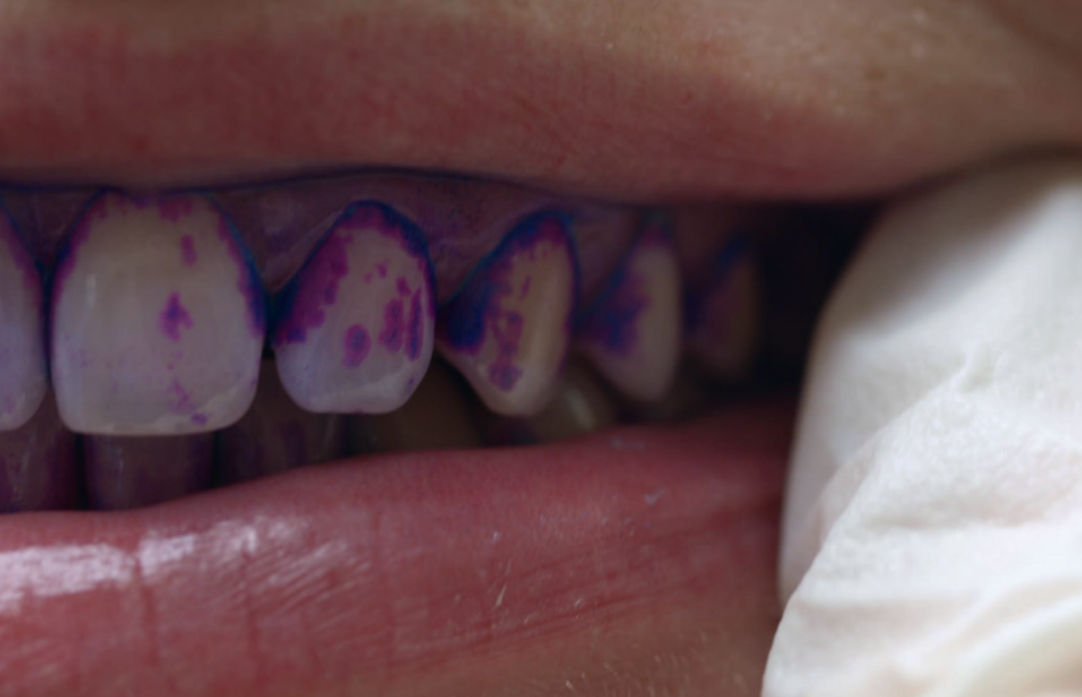 Biofilmas indikācija